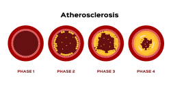 Atherosclerosis 
